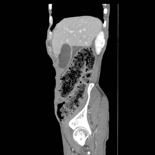 File:Acute pancreatitis (Radiopaedia 50213-55558 Sagittal C+ portal venous phase 5).jpg