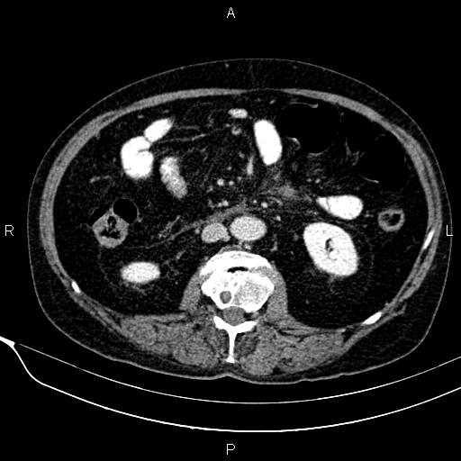 Acute pancreatitis (Radiopaedia 85146-100701 Axial C+ portal venous phase 34).jpg