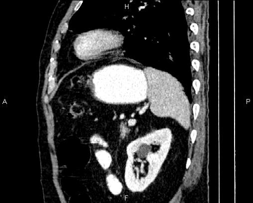 Acute pancreatitis (Radiopaedia 85146-100701 Sagittal C+ portal venous phase 72).jpg