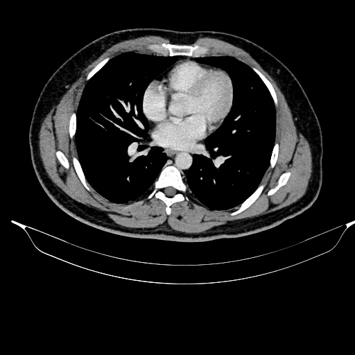 Acute pancreatitis (Radiopaedia 87428-103757 Axial C+ portal venous phase 9).jpg