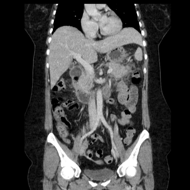 Acute pancreatitis - Balthazar C (Radiopaedia 26569-26714 Coronal C+ portal venous phase 33).jpg
