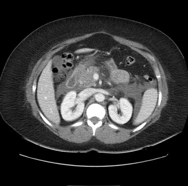File:Acute pancreatitis - Balthazar E (Radiopaedia 29016-29377 Axial C+ portal venous phase 25).png