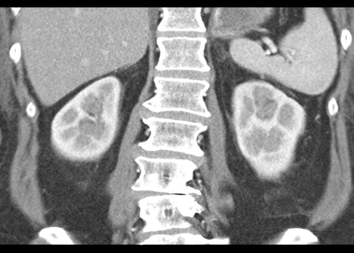 Acute pancreatitis and walled-off necrosis (Radiopaedia 29888-30403 Coronal C+ portal venous phase 41).jpg