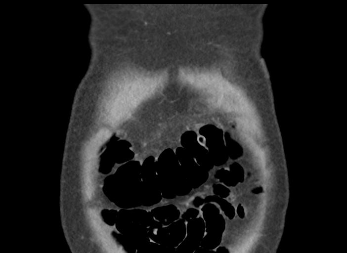 File:Acute pancreatitis and walled-off necrosis (Radiopaedia 29888-30404 Coronal C+ portal venous phase 7).jpg