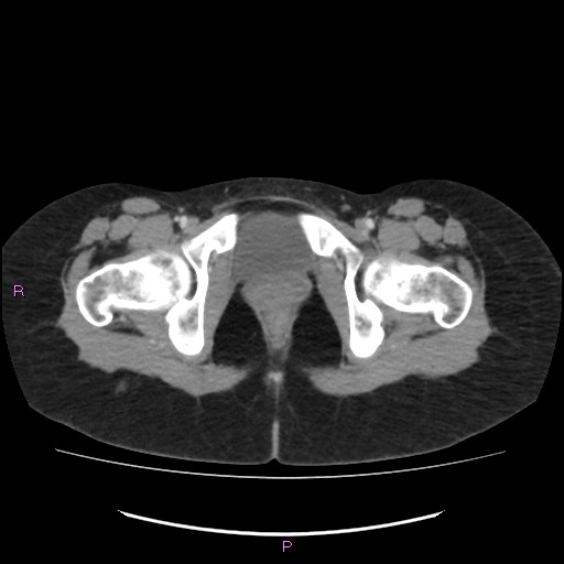 Acute pancreatitis secondary to stone at minor papilla and pancreatic divisum (Radiopaedia 76570-88333 Axial C+ portal venous phase 81).jpg