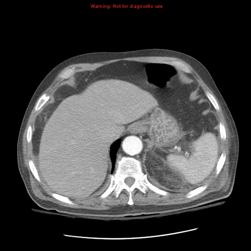 File:Acute pancreatitis with incidental pancreatic lipoma (Radiopaedia 10190-10730 Axial C+ arterial phase 21).jpg