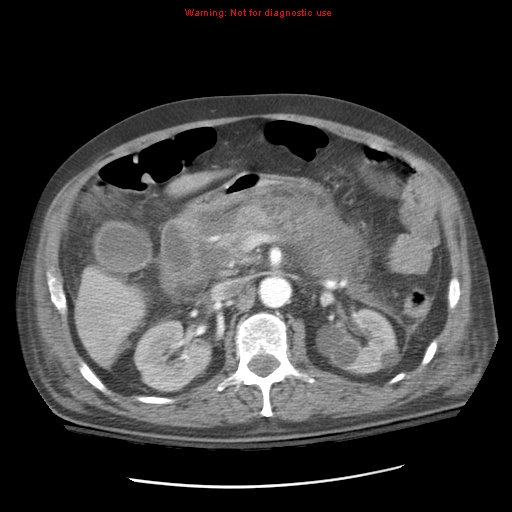 Acute pancreatitis with incidental pancreatic lipoma (Radiopaedia 10190-10730 Axial C+ arterial phase 40).jpg