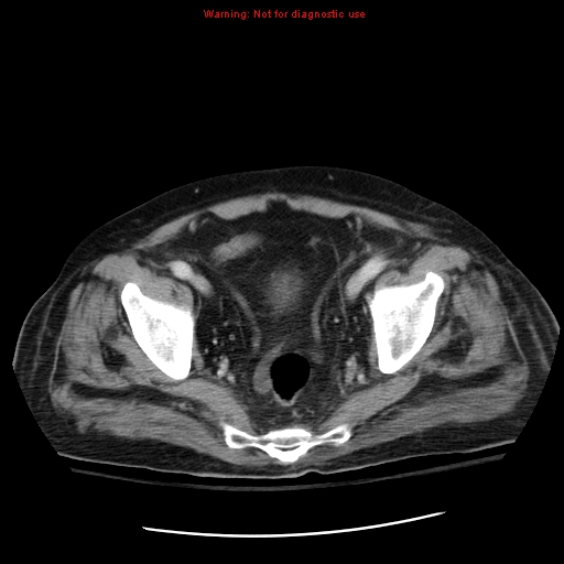 File:Acute pancreatitis with incidental pancreatic lipoma (Radiopaedia 10190-10730 Axial C+ portal venous phase 68).jpg