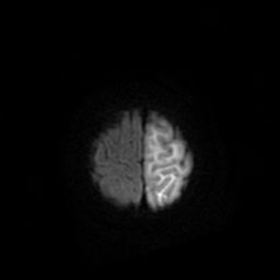 File:Acute phase of hemiconvulsion-hemiplegia epilepsy syndrome (Radiopaedia 29309-29745 Axial DWI 21).jpg