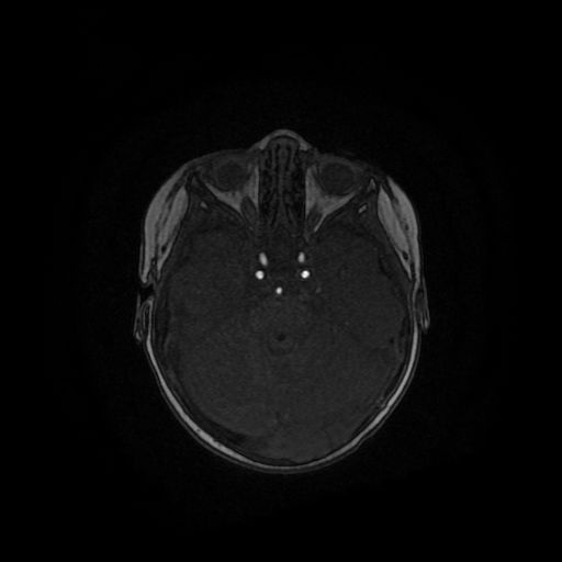 Acute phase of hemiconvulsion-hemiplegia epilepsy syndrome (Radiopaedia 29309-29745 Axial TOF angiography 104).jpg