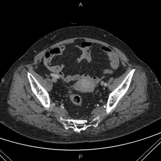 File:Acute renal artery occlusion (Radiopaedia 86586-102682 Axial C+ portal venous phase 82).jpg