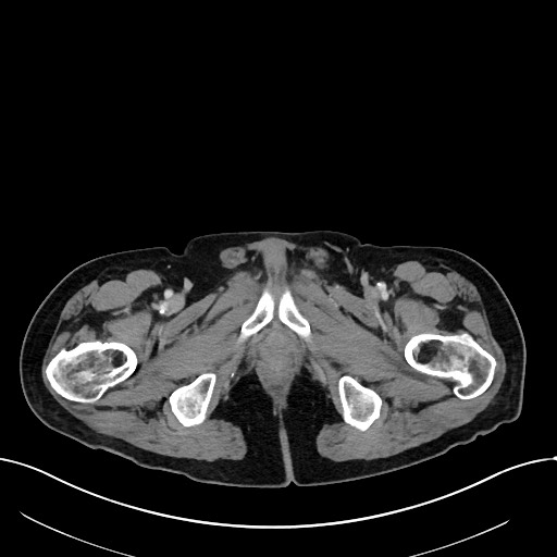 File:Acute renal infarction (Radiopaedia 59375-66736 Axial C+ portal venous phase 127).jpg