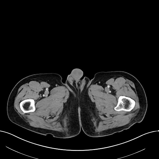 Acute renal infarction (Radiopaedia 59375-66736 Axial C+ portal venous phase 141).jpg