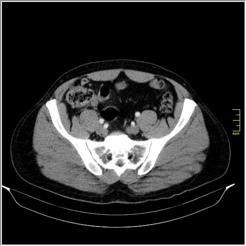 Acute right sided diverticulitis (Radiopaedia 65249-74268 Axial C+ portal venous phase 61).JPG