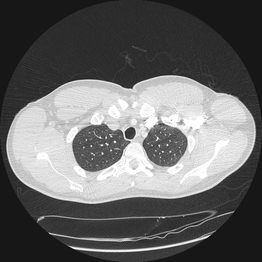 Acute segmental pulmonary emboli and pulmonary infarction (Radiopaedia 62264-70444 Axial lung window 28).jpg