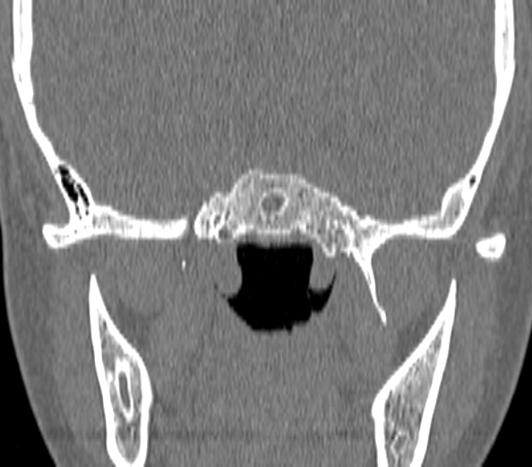 Acute sinusitis (Radiopaedia 40564-43158 Coronal bone window 42).jpg
