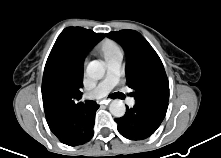 Acute small bowel (ileal) volvulus (Radiopaedia 71740-82139 Axial C+ portal venous phase 7).jpg