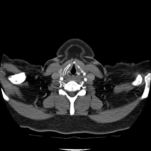 Acute subarachnoid hemorrhage and accessory anterior cerebral artery (Radiopaedia 69231-79009 Axial C+ arterial phase 40).jpg
