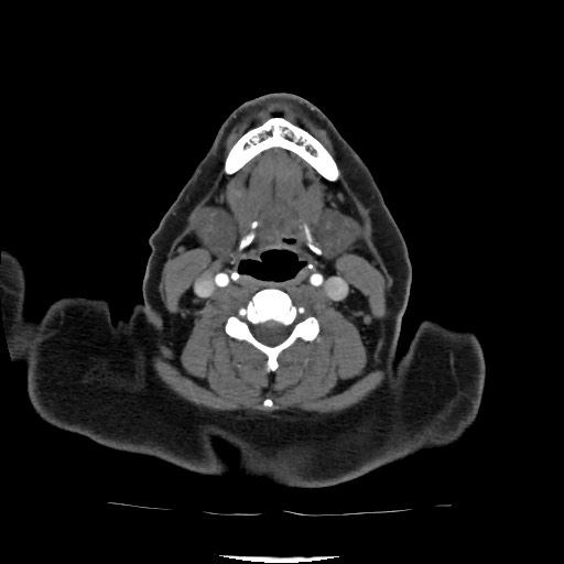Acute subarachnoid hemorrhage and accessory anterior cerebral artery (Radiopaedia 69231-79009 Axial C+ arterial phase 49).jpg