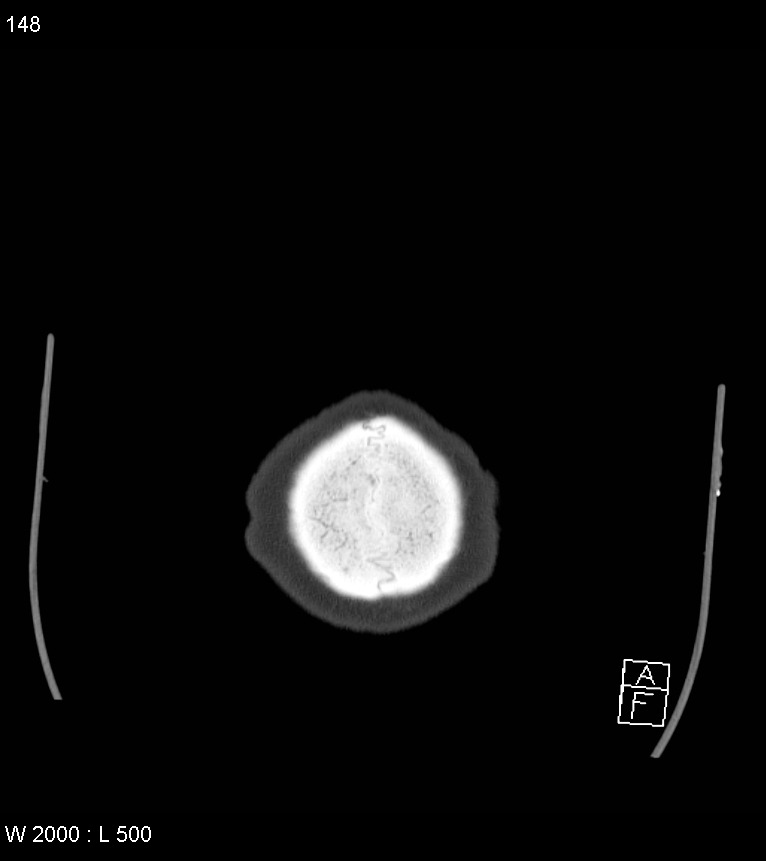 Acute subdural hematoma with myelofibrosis (Radiopaedia 52582-58494 Axial bone window 74).jpg