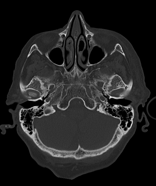 Acute traumatic subdural hematoma (Radiopaedia 82921-97257 Axial bone window 86).jpg