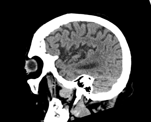 Acute traumatic subdural hematoma (Radiopaedia 82921-97257 Sagittal non-contrast 55).jpg