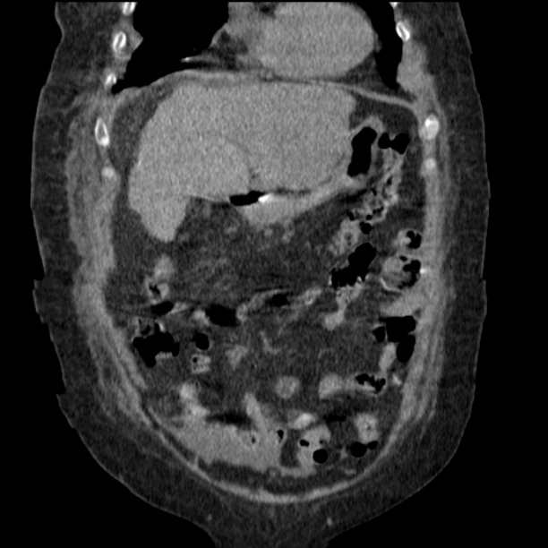 Acute tubular necrosis (Radiopaedia 28077-28334 D 27).jpg