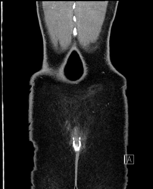 Acute uncomplicated appendicitis (Radiopaedia 61374-69304 Coronal C+ portal venous phase 104).jpg