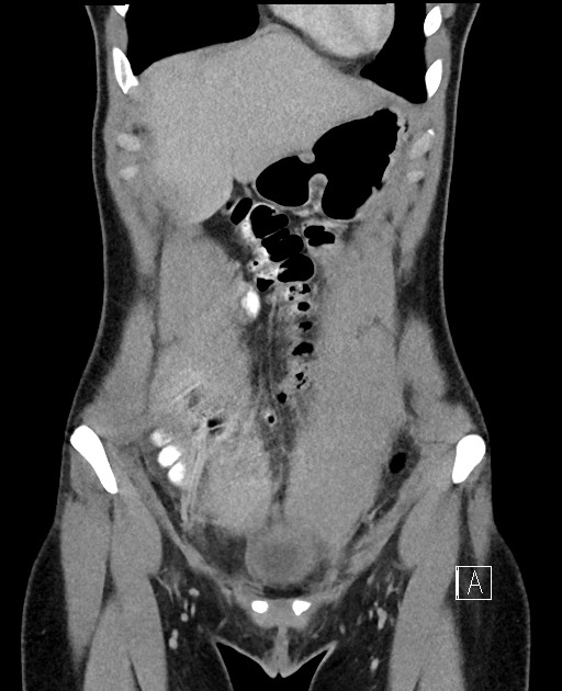 Acute uncomplicated appendicitis (Radiopaedia 61374-69304 Coronal C+ portal venous phase 22).jpg