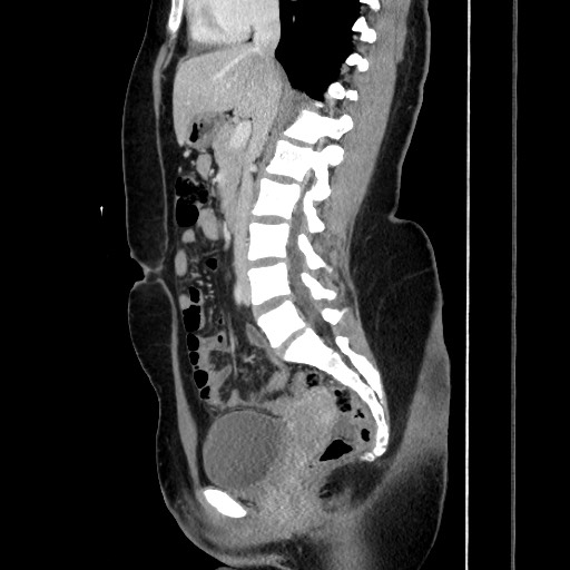 Acute uncomplicated appendicitis (Radiopaedia 73704-84499 Sagittal C+ portal venous phase 108).jpg