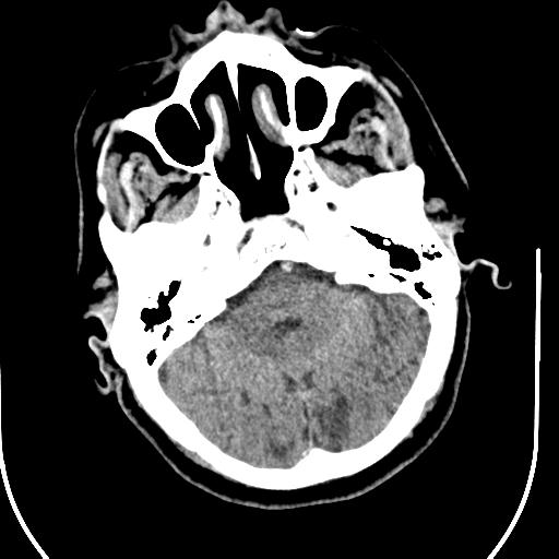 Acute vertebrobasilar ischemic infarction (Radiopaedia 25220-25473 Axial non-contrast 16).jpg