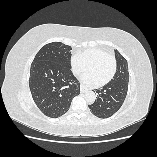Adenocarcinoma in situ of lung (Radiopaedia 38685-40829 B 147).png