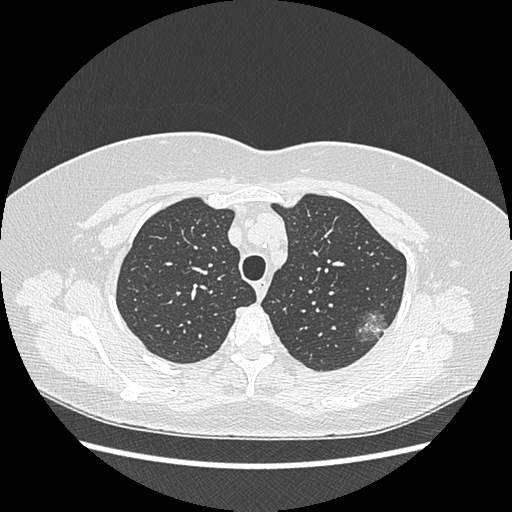 Adenocarcinoma in situ of lung (Radiopaedia 38685-40829 B 54).png