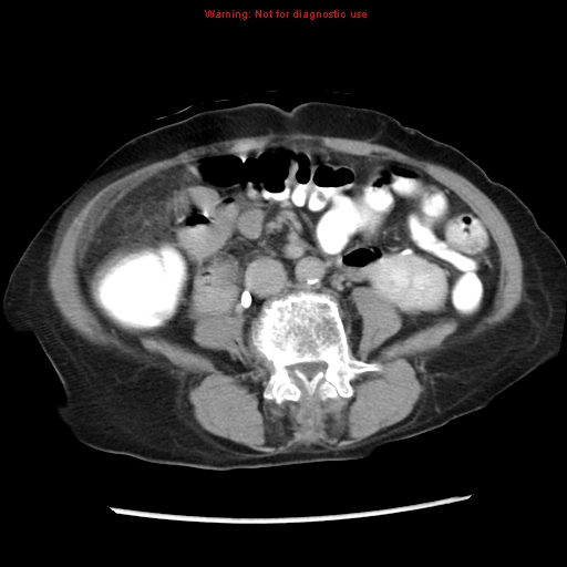 Adenocarcinoma of the colon (Radiopaedia 8191-9039 Axial renal excretory phase 29).jpg