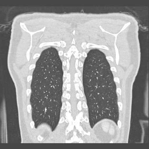 Adenocarcinoma of the lung (Radiopaedia 59871-67325 Coronal lung window 57).jpg