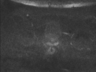Adenocarcioma of rectum- T1 lesion (Radiopaedia 36921-38546 Axial DWI 71).png