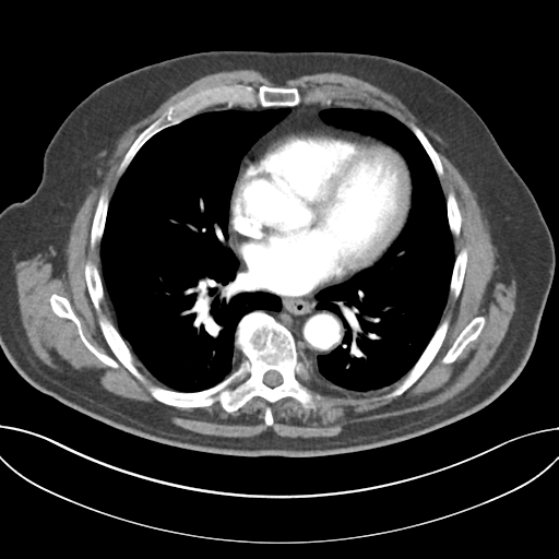 Adenocarcioma of rectum- T1 lesion (Radiopaedia 36921-38547 Axial C+ arterial phase 33).png