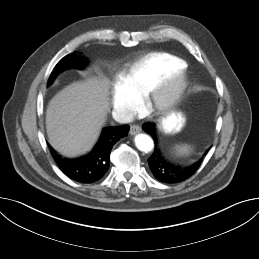 Adenocarcioma of rectum- T1 lesion (Radiopaedia 36921-38547 Axial C+ arterial phase 42).png