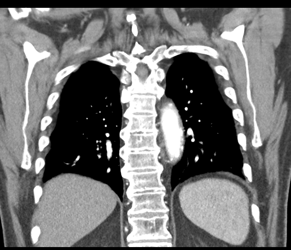File:Adenocarcioma of rectum- T1 lesion (Radiopaedia 36921-38547 Coronal C+ arterial phase 47).png