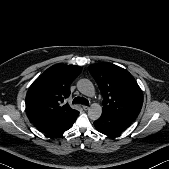 Adenoid cystic carcinoma of the trachea (Radiopaedia 49042-54137 Axial non-contrast 114).jpg