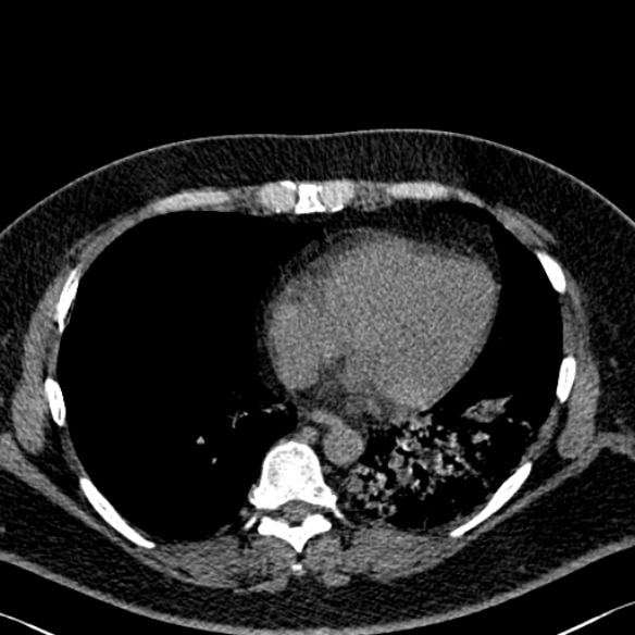 Adenoid cystic carcinoma of the trachea (Radiopaedia 49042-54137 Axial non-contrast 237).jpg