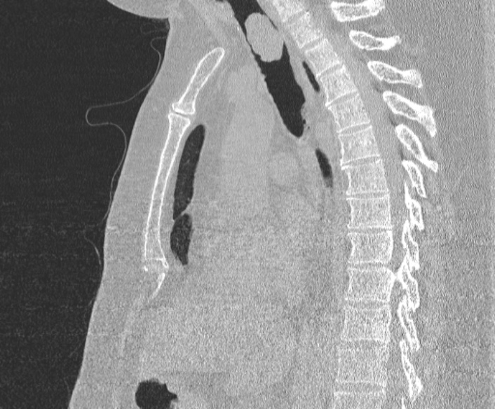 File:Adenoid cystic carcinoma of the trachea (Radiopaedia 49042-54137 Sagittal lung window 238).jpg