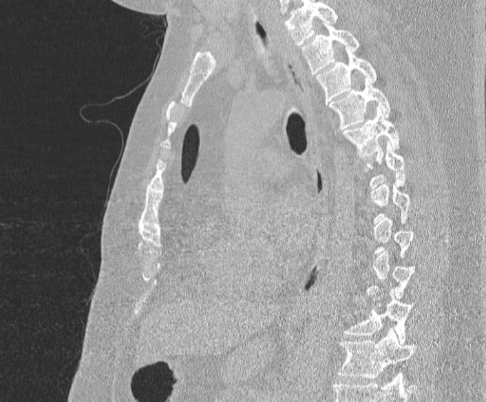 Adenoid cystic carcinoma of the trachea (Radiopaedia 49042-54137 Sagittal lung window 254).jpg