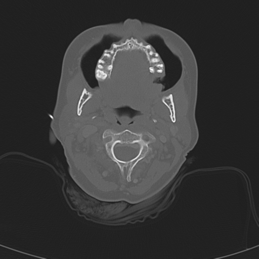 Adenoid cystic tumor of palate (Radiopaedia 46980-51518 Axial bone window 31).png