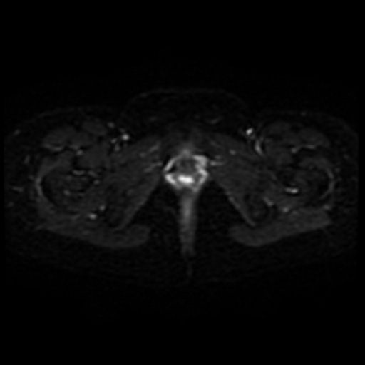 File:Adenoma malignum of cervix (Radiopaedia 66441-75705 Axial DWI 21).jpg