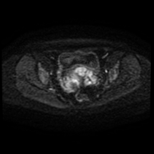 Adenoma malignum of cervix (Radiopaedia 66441-75705 Axial DWI 63).jpg