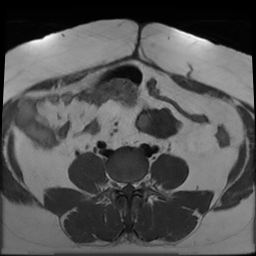 File:Adenomyosis within a didelphys uterus (Radiopaedia 70175-80215 Axial T1 10).jpg
