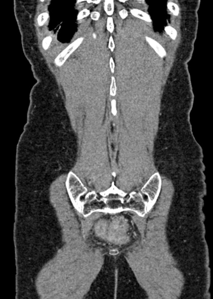 Adhesional small bowel obstruction (Radiopaedia 48397-53305 Coronal C+ portal venous phase 310).jpg
