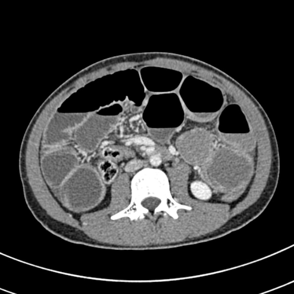 Adhesional small bowel obstruction (Radiopaedia 52107-57980 Axial C+ portal venous phase 60).jpg