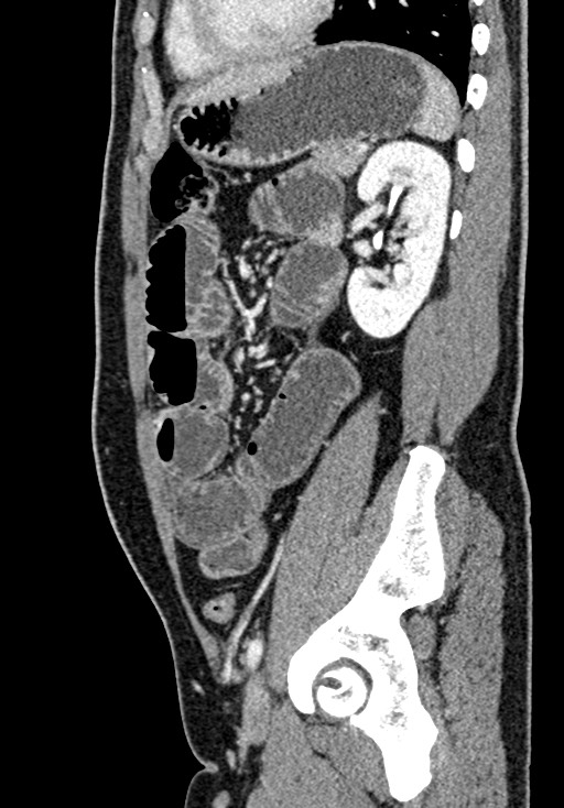 Adhesional small bowel obstruction (Radiopaedia 58900-66131 Sagittal C+ portal venous phase 175).jpg